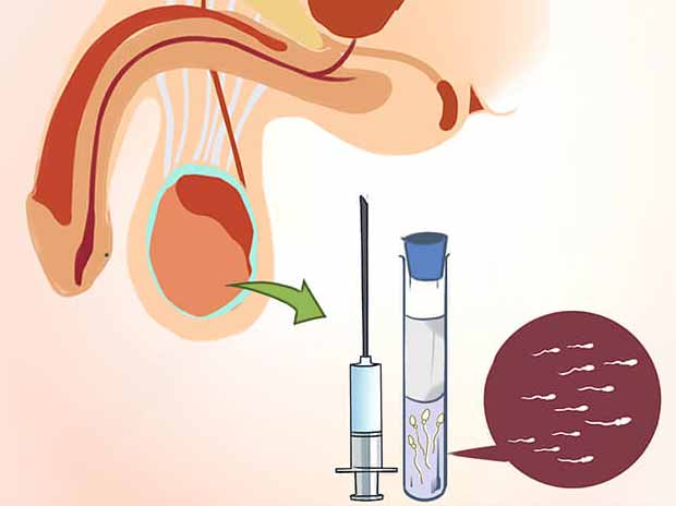 Surgery- maa fartility