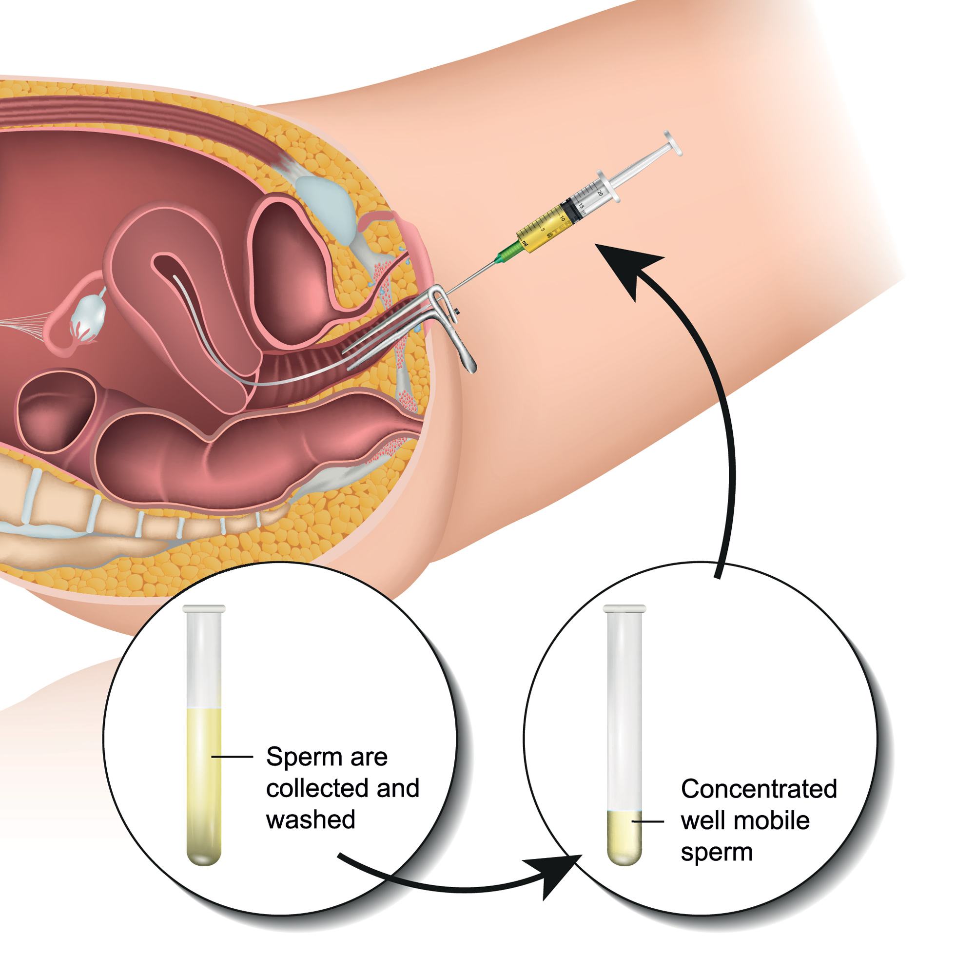 Surgery- maa fartility